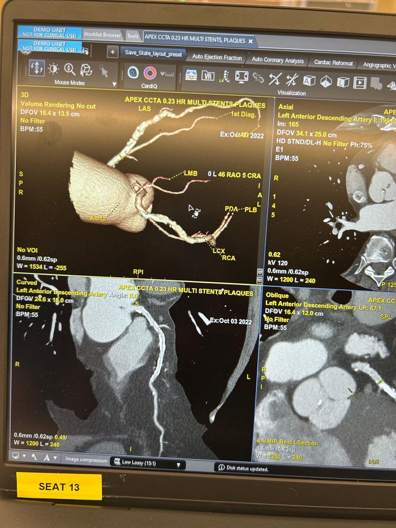 Cardiac CT images in the GE HealthCare imaging software